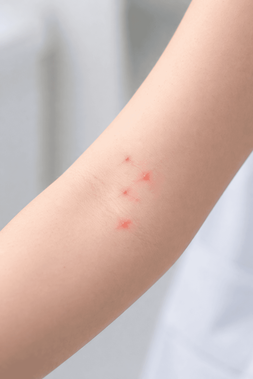 piqûres punaises de lit réactions cutanées