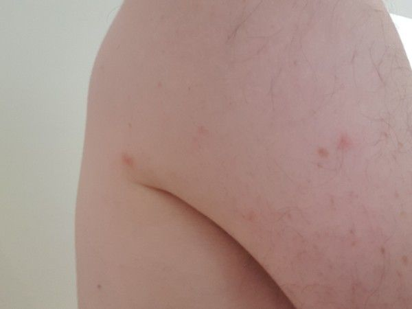 Piqûres de punaises de lit sur la peau